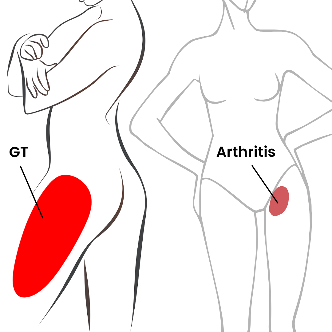 Illustration highlighting two common sites for intramuscular injections.